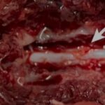 【病例】犬罕见“碰撞瘤”！14岁狗的腰骶肿块竟是两种罕见肿瘤的“碰撞”