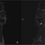 【病例】14岁老猫“脑脓肿”命悬一线！3D打印+开颅手术，它竟奇迹生还？